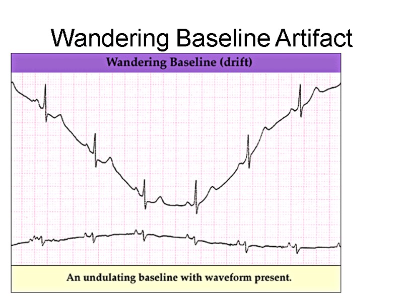 Wandering Baseline Artifact